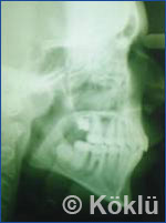 Röntgenbild nach einer Behandlung